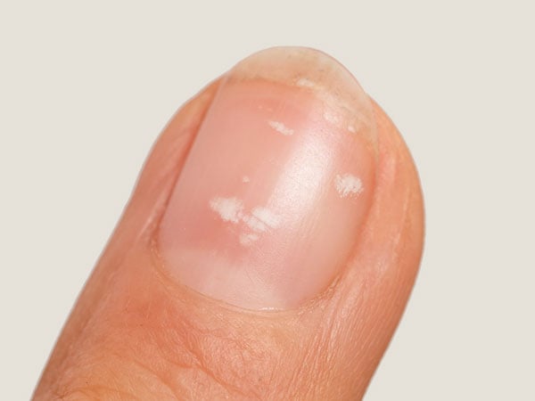 Dispelling the Myths: White Spots on Nails Not a Sign of Calcium Deficiency